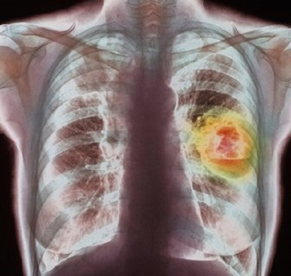 סרטן ריאות - צילום חזה
