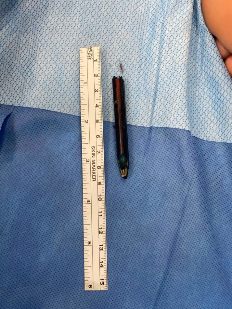 העיפרון שהוצא מגופו של הילד (צילום: הקריה הרפואית רמב"ם)