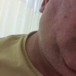 הפנים הנפוחות של אסף לוי שהותקף בכניסה לעכו (צילום עצמי)