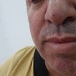שבר באף אצל אסף לוי שהותקף בכניסה לעכו וזקוק לניתוח (צילום עצמי)
