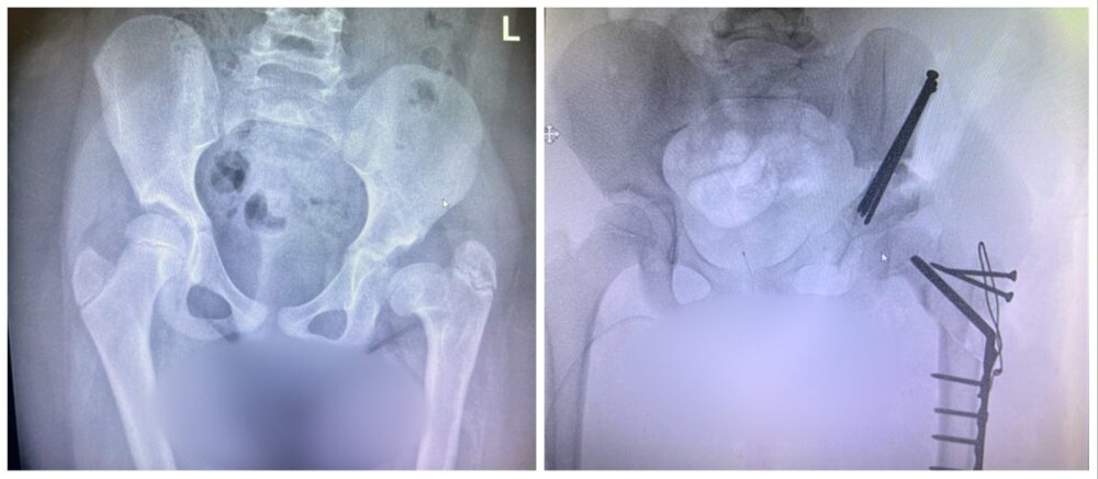 צוואר הירך של ס', לפני ואחרי הניתוח (צילום: הקרייה הרפואית רמב״ם)