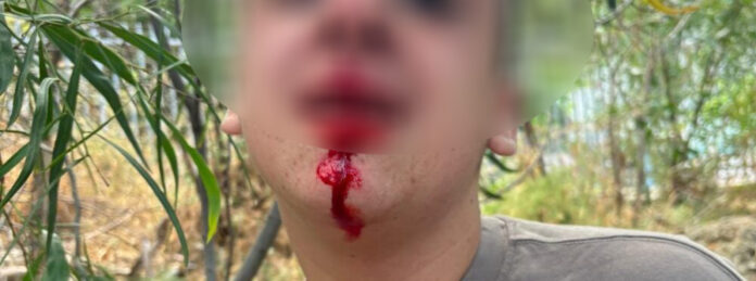 תלמיד שהותקף ושיניו נעקרו - בית הספר ליאו באק (צילום: אלבום פרטי)