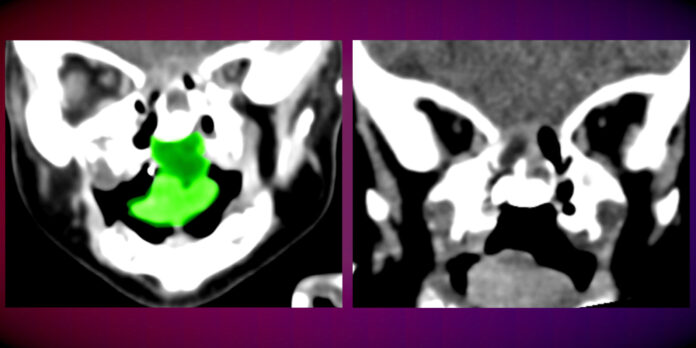 צילומי C.T של הפעוטה לפני (משמאל) ואחרי הניתוח. במרכז הצילום מימין ניתן לראות את החלל שנותר לאחר הסרת הגידול (צילום הקריה הרפואית רמב