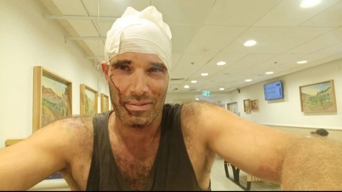 יובל, תושב חיפה, נפצע בראשו במסיק בכפר הפלסטיני בורין (צילום: אלבום אישי)