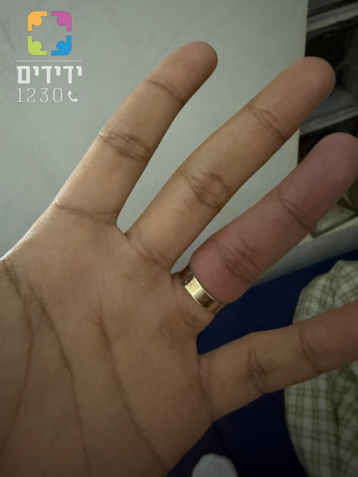 טבעת נתקעה באצבע (צילום: ארגון ידידים)